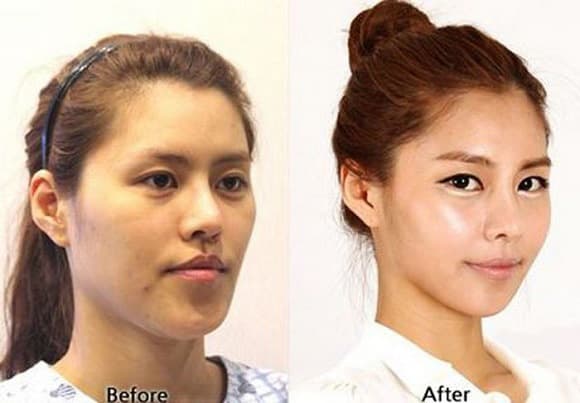 عمليات تجميل الوجه قبل وبعد