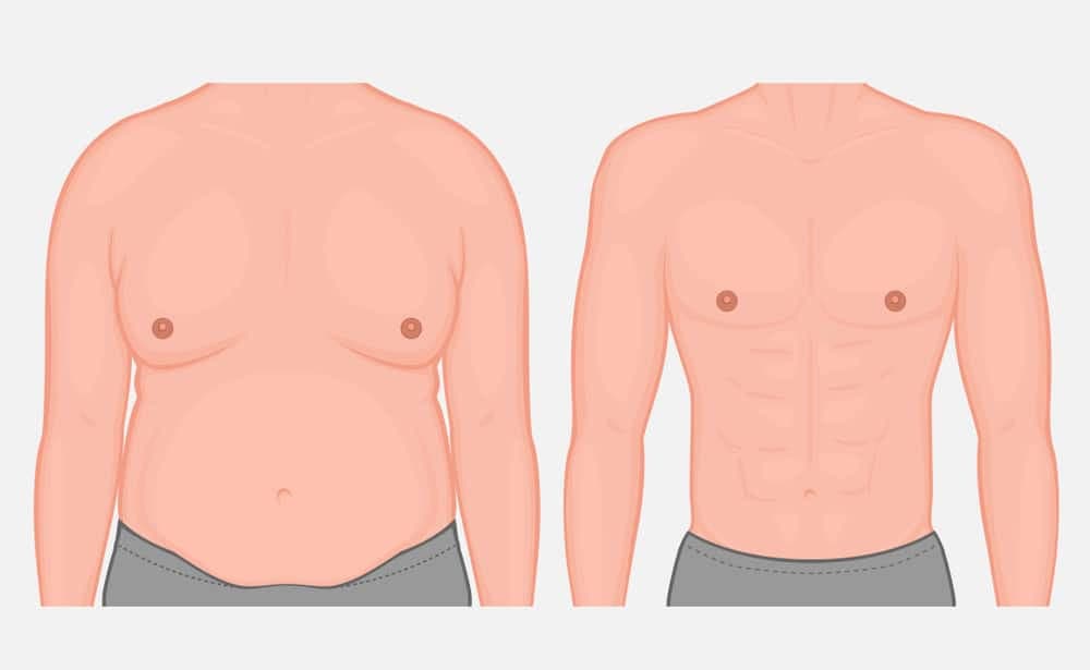 عمليات تجميل الثدي عند الرجال