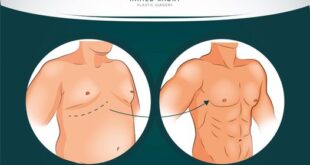 عملية تجميل الثدي للرجال