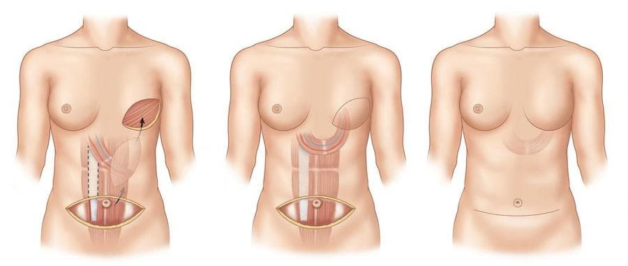 شكل الثدي بعد استئصال الورم