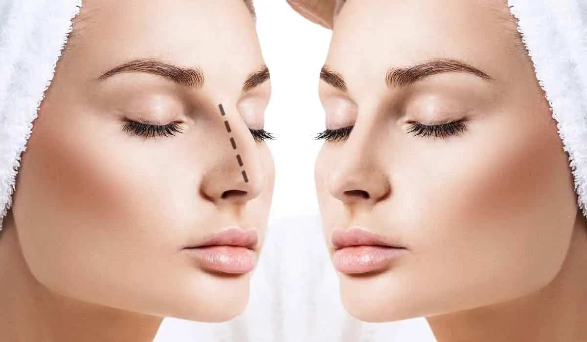 عمليات تجميل الانف بدون جراحة